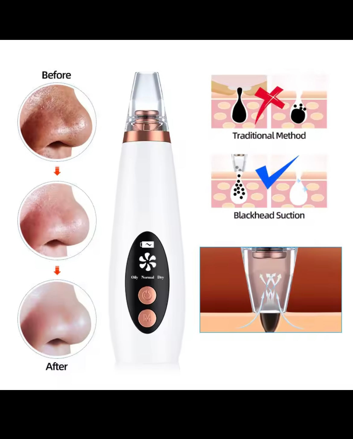 Extracteur de Points Noirs Électrique – Peau Propre & Lisse en 2 Minutes | Rechargeable